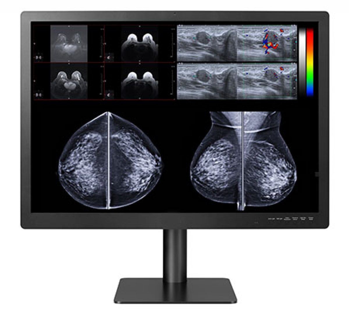 Calibrated Digital Mammography Scale